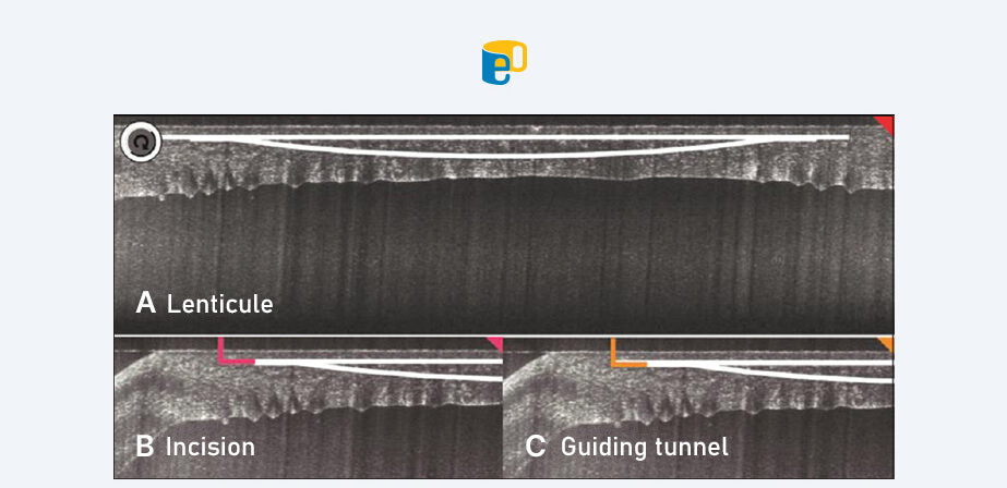 CLEAR LASIK Benefit Images 3