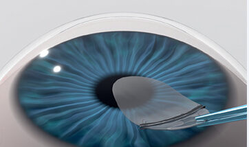 CLEAR LASIK Surgery Process Images 2
