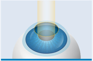 LASIK Image