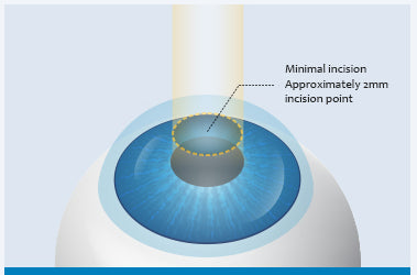CLEAR LASIK Image