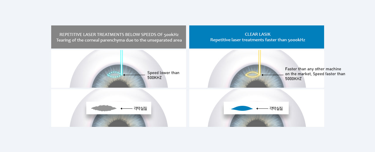 CLEAR LASIK Benefit Images 1