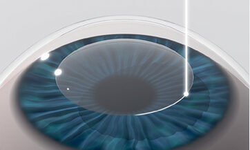 CLEAR LASIK Surgery Process Images 1
